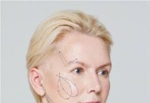 Нитевые методы омоложения АПТОС