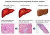 Гепабене: нормализует функцию печени при различных хронических патологических состояниях