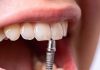 Возможности современной имплантации зубов