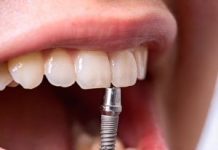 Возможности современной имплантации зубов