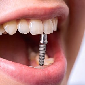 Возможности современной имплантации зубов