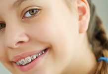 Как выглядит брекет-система для детей?