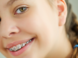 Как выглядит брекет-система для детей?