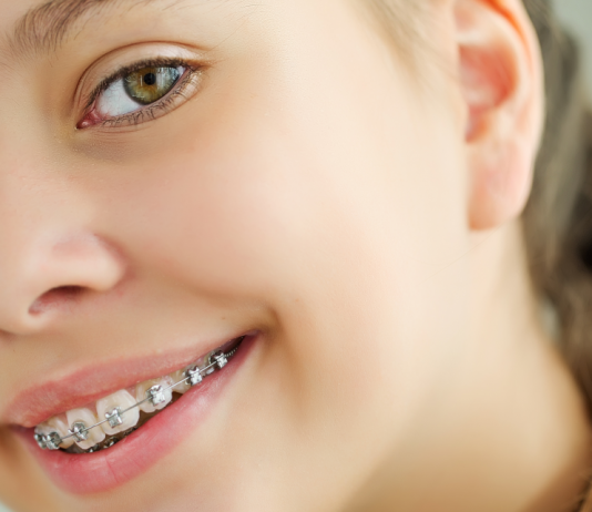 Как выглядит брекет-система для детей?