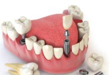 Имплантация зубов: плюсы и минусы