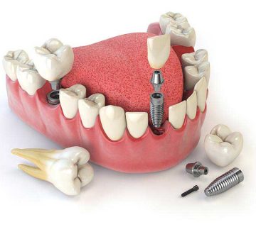Имплантация зубов: плюсы и минусы