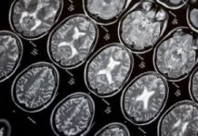 Методы лечения рассеянного склероза