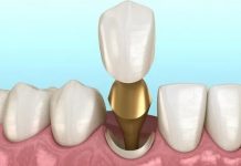 Когда нужно ставить коронку на зуб?