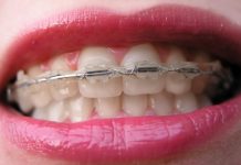 Преимущества брекет-систем