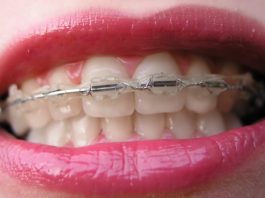 Преимущества брекет-систем