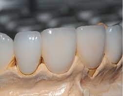 Почему стоит поставить циркониевую коронку?