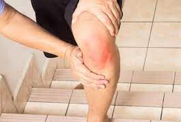 Как определить воспаление суставной сумки коленного сустава?