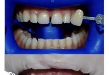 Отбеливание зубов в клинике «Кристалл»