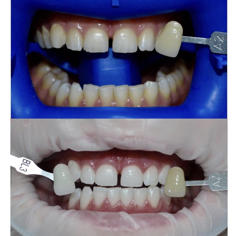 Отбеливание зубов в клинике «Кристалл»