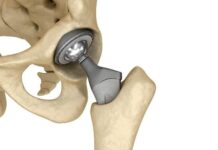 Когда необходимо эндопротезирование тазобедренного сустава