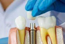 Преимущества дентальных имплантов Dentis