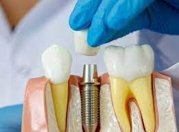 Преимущества дентальных имплантов Dentis