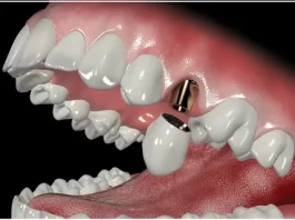 Что такое временный титановый абатмент и где он применяется