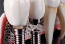 Имплантация: безопасный и эффективный способ восстановления зубов