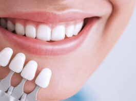 Композитные виниры: преимущества, особенности и порядок установки