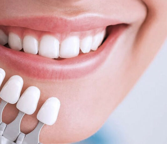 Композитные виниры: преимущества, особенности и порядок установки