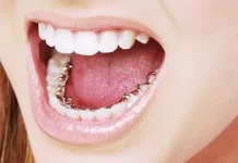 Лингвальные брекеты Incognito: особенности, преимущества и этапы установки