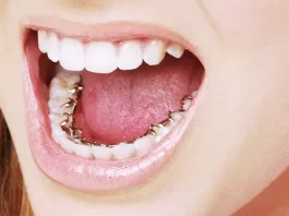 Лингвальные брекеты Incognito: особенности, преимущества и этапы установки