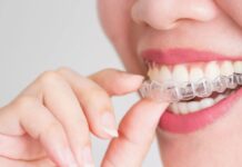 Исправление прикуса: зачем нужны брекеты и как они работают