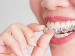Исправление прикуса: зачем нужны брекеты и как они работают