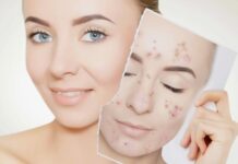 Как функциональная косметика помогает избавиться от акне