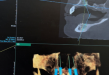 Синус-лифтинг: суть процедуры и показания к проведению