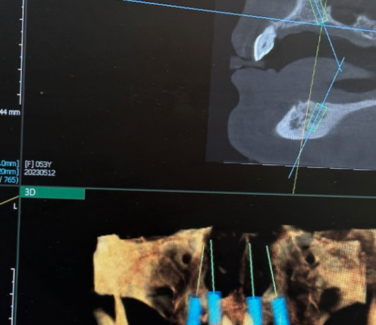 Синус-лифтинг: суть процедуры и показания к проведению